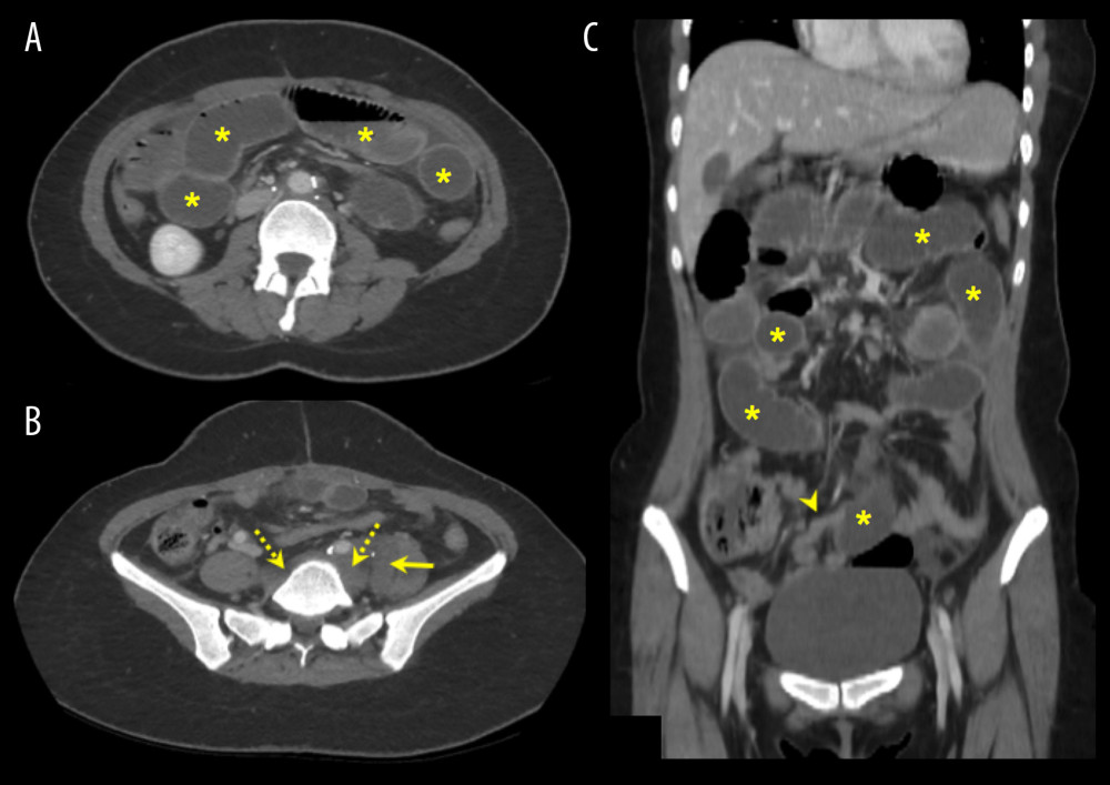 Contrast-enhanced. (A, B) Axial and (C) coronal computed tomography scans of the abdomen performed 9 months after surgery. They show interval development of small bowel obstruction (asterisks) with a transition zone at the distal ileum (arrowhead). A residual retroperitoneal mass is still visible medial to the left psoas muscle (marrow) and in the perivertebral region at the level of L4 and L5 (dotted arrows).