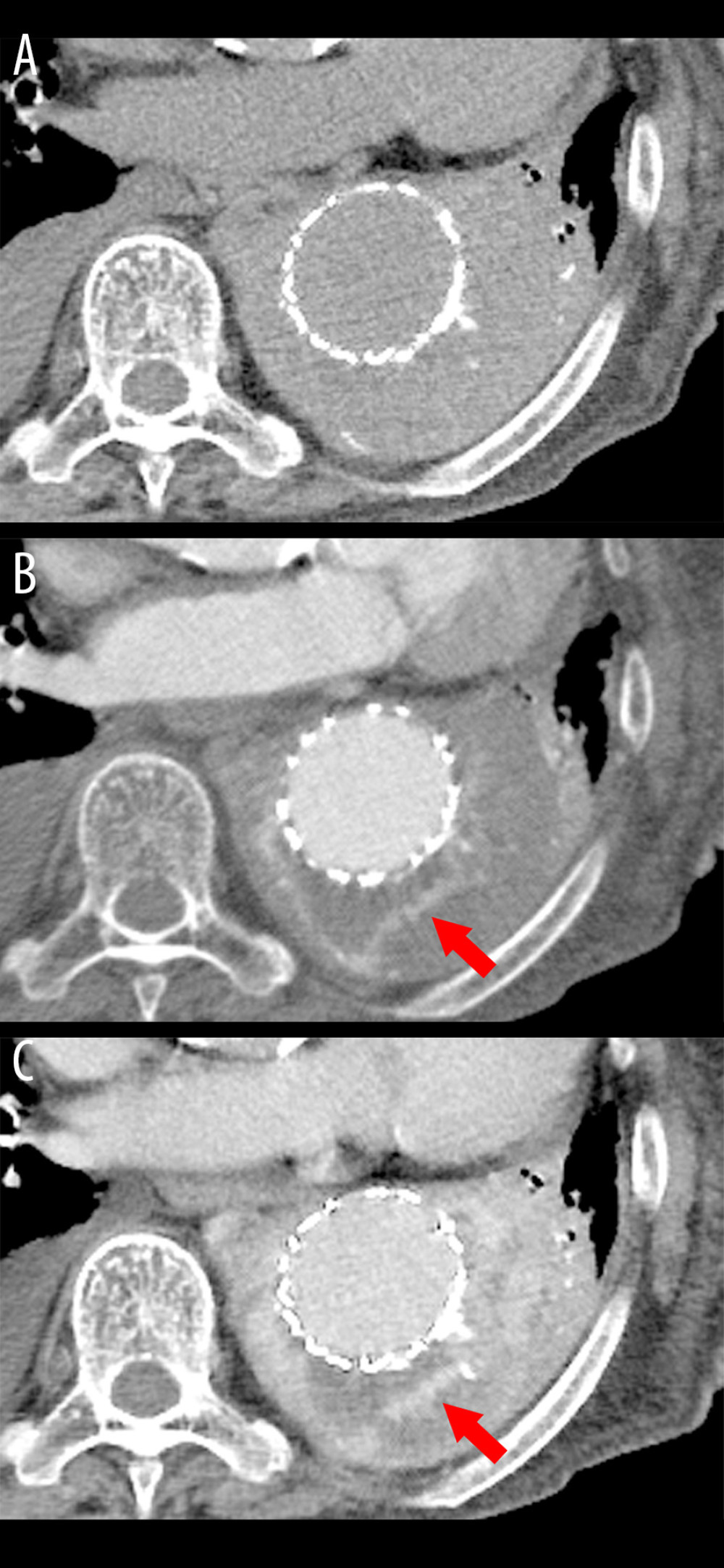 (A) Non-contrast, (B) arterial-phase, and (C) delayed post-contrast computed tomography images. They showed a crescent-shaped aortic aneurysm with endoleak (red arrows), approximately 6 cm in size, surrounding the stent graft.