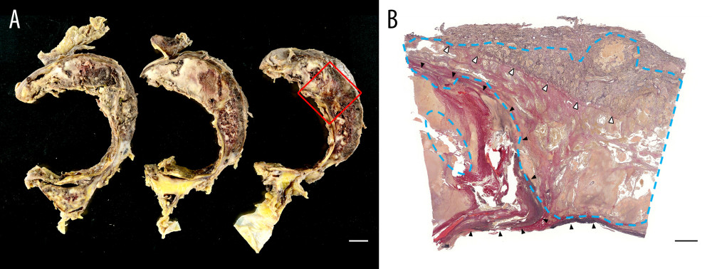 (A) Cross-sections of the thoracic descending aortic wall after removal of the stent graft. A crescent-shaped aneurysm-like mass with severe hemorrhage was shown along with aortic wall. This mass corresponded to the lesion shown in Figure 1. (B) Elastica van Gieson stain corresponding to the area surrounded by the red square in (A). The tumor (surrounded by blue dashed line) mainly located in the aortic wall and destroyed aortic media (black arrowheads) and focally invaded into the lung through the pleura (white arrowheads). Below the pleura was the aortic wall and above the pleura was the left lower lobe of the lung. Bars, (A) 10 mm, (B) 2 mm.