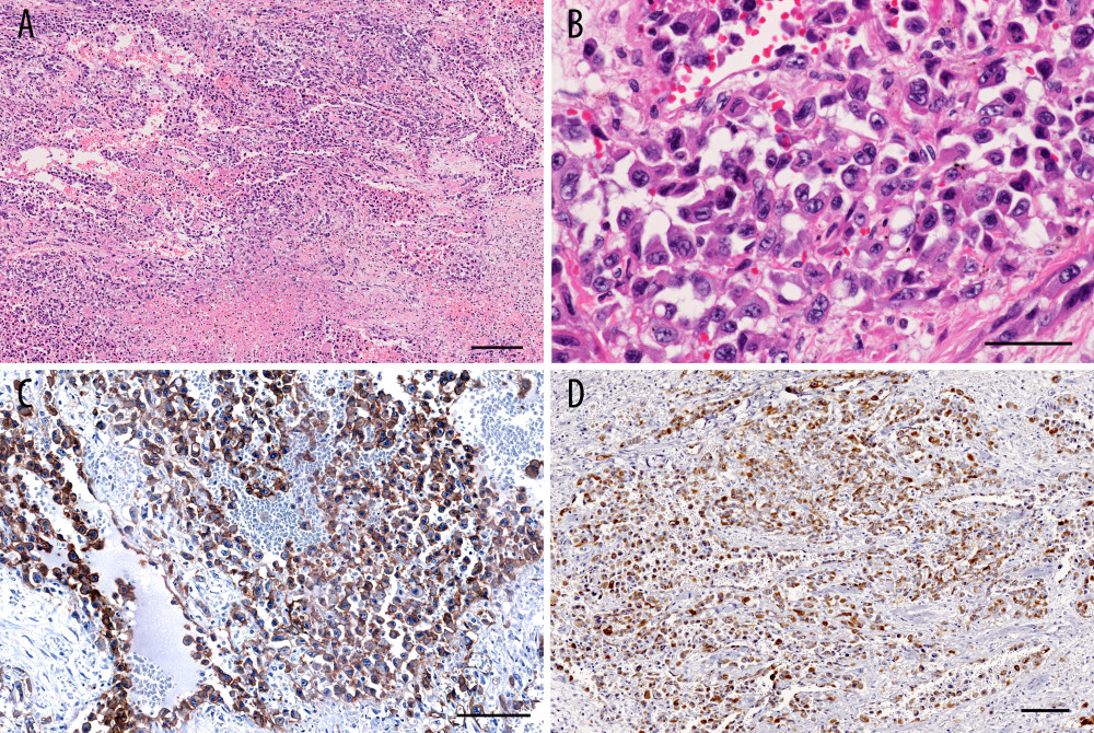 (A, B) Hematoxylin and eosin stain of the tumor. The tumor cells formed (A) a sinusoidal pattern with hemorrhage, fibrin deposition, thrombi, and necrosis and showed (B) severe cellular atypia and appeared to have an intercellular adhesive property which suggested epithelioid features. (C) CD31 and (D) AE1/AE3 stain of the tumor. The tumor cells were positive for CD31, indicating vascular endothelial differentiation, and AE1/AE3, meaning epithelioid feature. Bars, (A, D) 200 μm, (B) 50 μm, (C)100 μm.