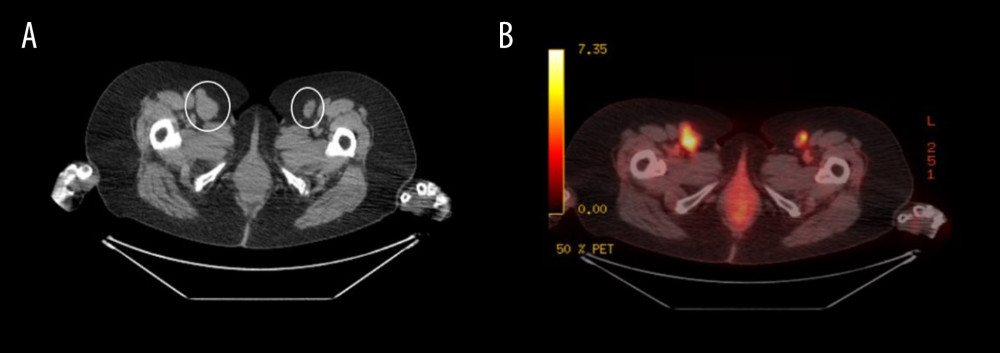 CT chest/abdomen/pelvis with PET axial views showing enlarged bilateral inguinal lymph nodes with right approximately 3.2 cm and left 2.6 cm in diameter (A) with corresponding increased FDG activity on the PET scan, right more prominent than the left (B).