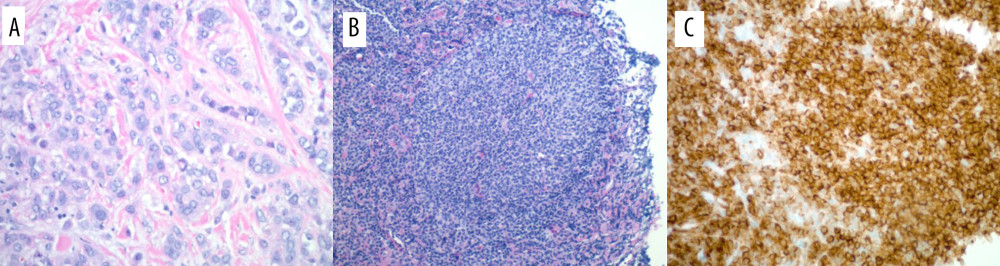 (A) Right breast specimen showing invasive lobular carcinoma (H&E 20× power). (B) Right inguinal lymph node specimen showing scattered atypical lymphoid follicles (H&E 10×). (C) Lymphoid follicles staining positive for BCL-2 (20×) suggesting follicular lymphoma.