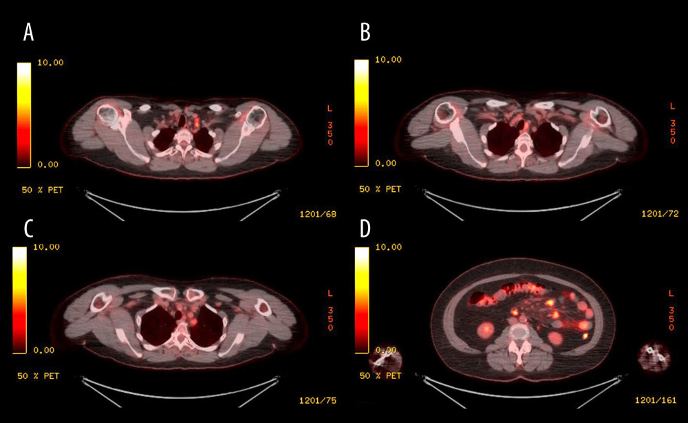 PET chest/abdomen/pelvis scan Axial views showing increase FDG uptake in multiple nodes in the thoracic inlet deep to left subclavian vein (A), left of upper trachea (B), superior to aortic arch (C) and numerous nodes along the root of the mesentery (D).