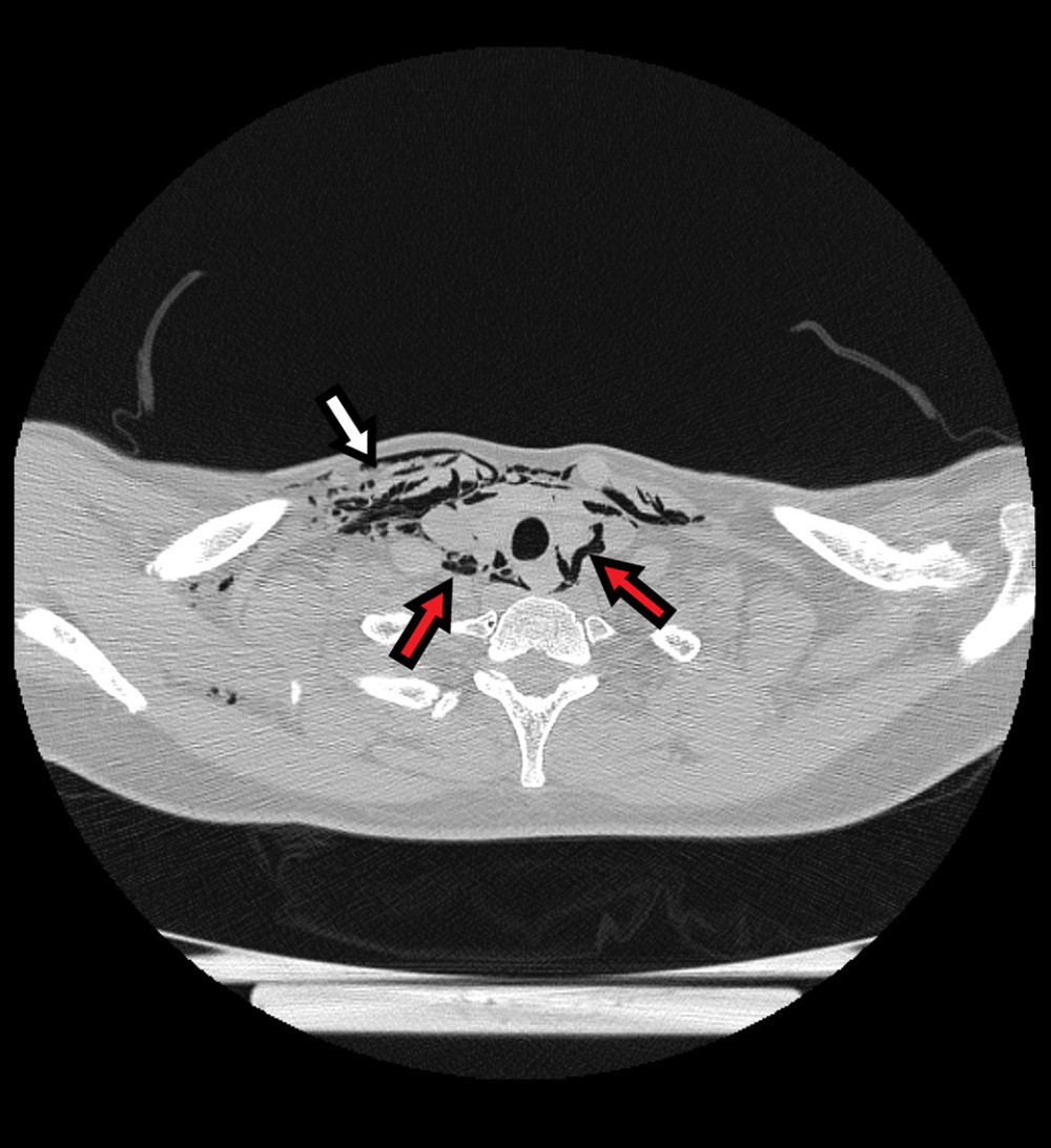 Computed tomographic axial view of the emphysema in the chest wall (white arrows) and in the mediastinum, outlining the vessels and thyroid (red arrows).