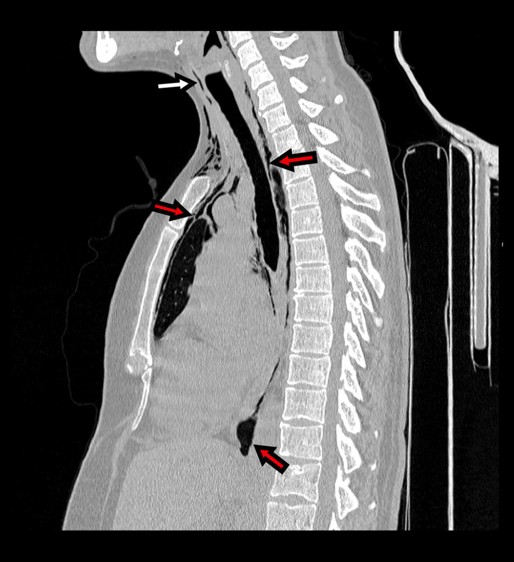 Sagittal neck and chest computed tomography scan demonstrates free air in the subcutaneous tissue of the chest and neck (white arrows) and gas surrounding the vessels, esophagus, trachea, and posterior pericardium (red arrows).