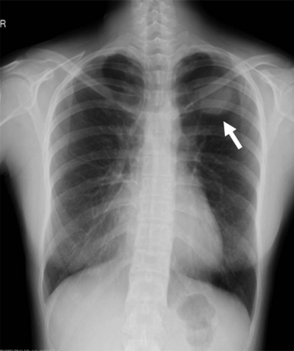 Chest X-ray examination shows a lesion on the left first rib (arrow).