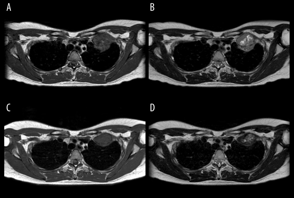 (A) T1-weighted and (B) T2-weighted magnetic resonance images show an axial view prior to denosumab therapy. (C) T1-weighted and (D) T2-weighted magnetic resonance images at 4 months after denosumab therapy.