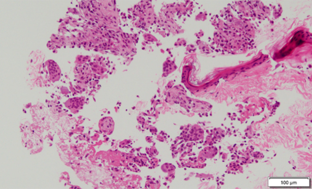 Microscopic images of the tumor specimen prior to denosumab therapy (hematoxylin and eosin staining). The tumor demonstrates diffuse proliferation of multinucleated, osteoclast-like giant cells and uniform ovoid- to spindle-shaped mononuclear stromal cells.