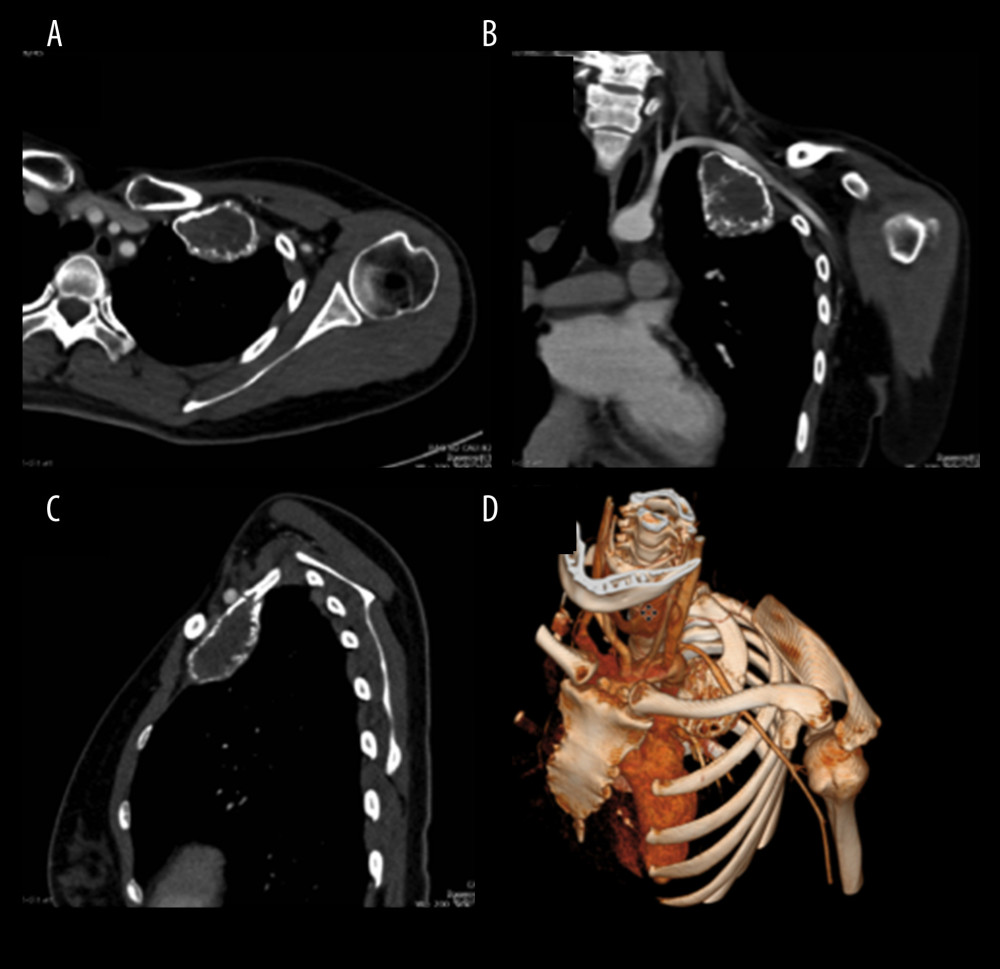 Computed tomography images 6 months after starting denosumab therapy. (A) Axial view. Significant tumor shrinkage and calcified sclerotic rim compared with pretreatment images (Figure 2). (B) Sagittal view. (C) Coronal view. (D) Three-dimensional reconstruction of computed tomography arteriography shows the subclavian artery passing between the tumor of the first rib and clavicle.