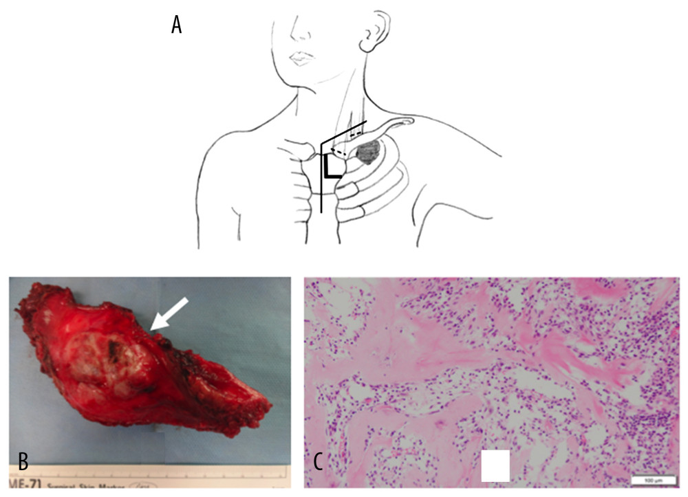 (A) Skin incision (thin solid line), L-shaped sternal division (thick solid line), and release of the sternal head and the clavicular head of the sternocleidomastoid muscle from its origin (dashed line) are illustrated. (B) Gross specimen and pathological findings. The tumor in the first rib was resected. The tumor (arrow) was covered by smooth pleura. (C) A microscopic view shows diffuse proliferation of short, spindle-shaped cells without nuclear atypia, as well as osteoid formation and extensive fibrosis throughout the entire specimen. No giant cells are observed (hematoxylin and eosin staining).