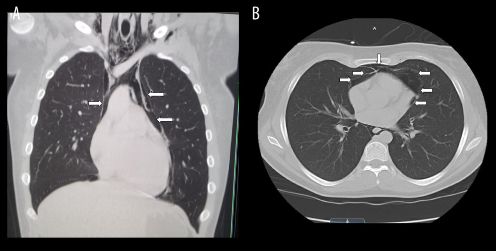 (A) Coronal computed tomography scan of the chest. Arrows point to the extensive pneumomediastinum and pneumopericardium. There is gas along the great vessels, aorta, trachea, and esophagus. (B) Axial computed tomography scan of the chest. Arrows point to the extensive pneumomediastinum and pneumopericardium.