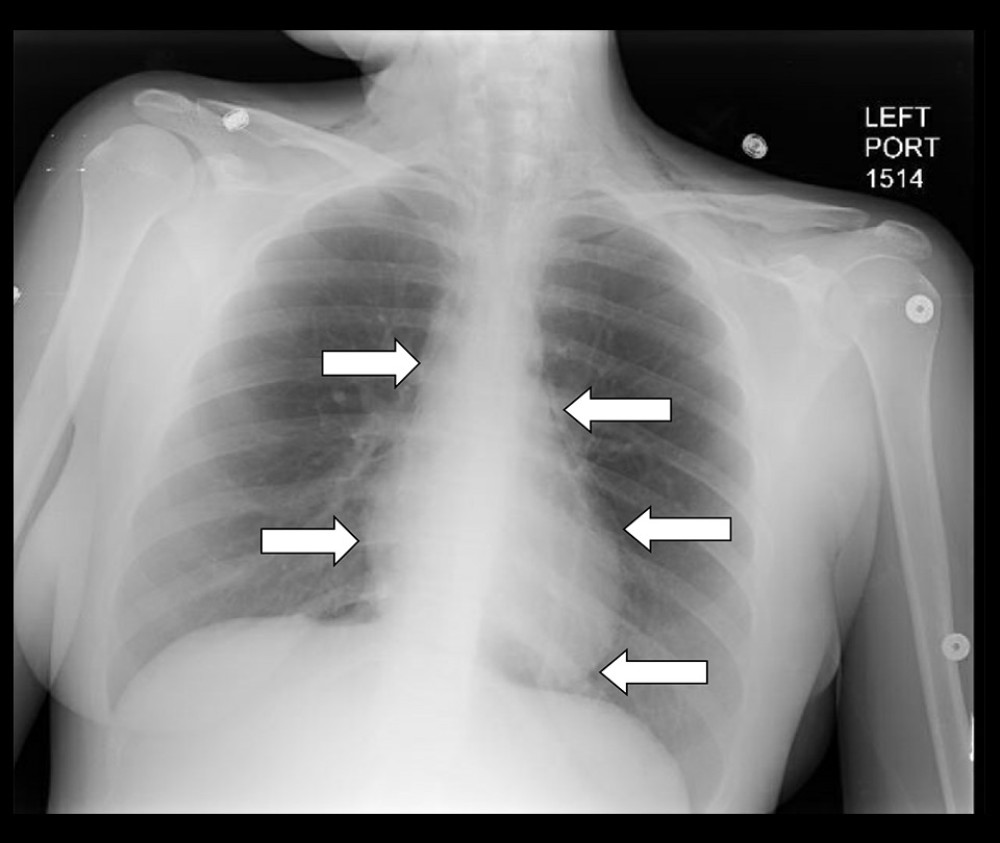 Anteroposterior X-ray of the chest. Arrows point to the reduction in the size of pneumomediastinum, without visualization of pneumothorax.