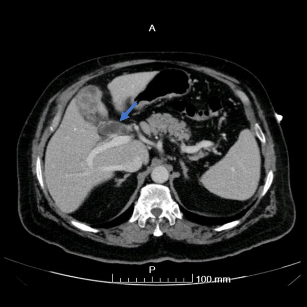 CT scan of the abdomen and pelvis showed CBD stone (arrow) compressing the CHD.