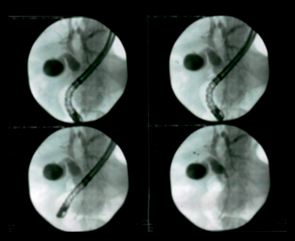 ERCP imaging showing a stent in CBD.