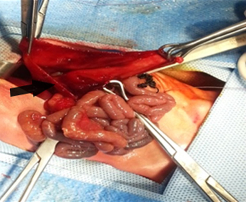 Huge gastric perforation with ischemic necrosis of the gastric wall (arrow).