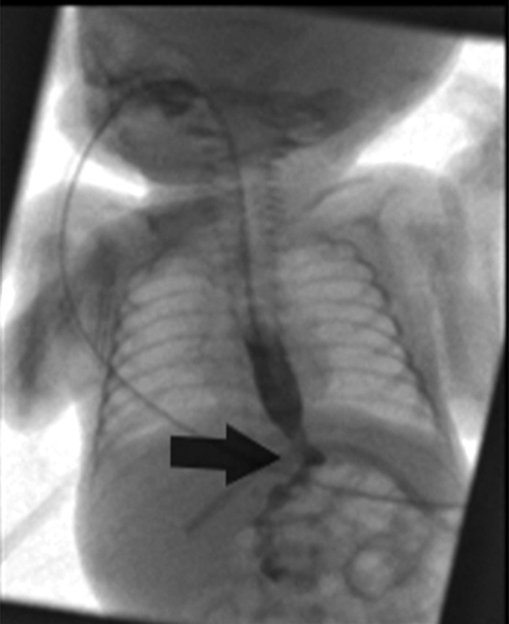 Postoperative upper GIT study shows eso-antral anastomosis without leak or stricture (arrow).