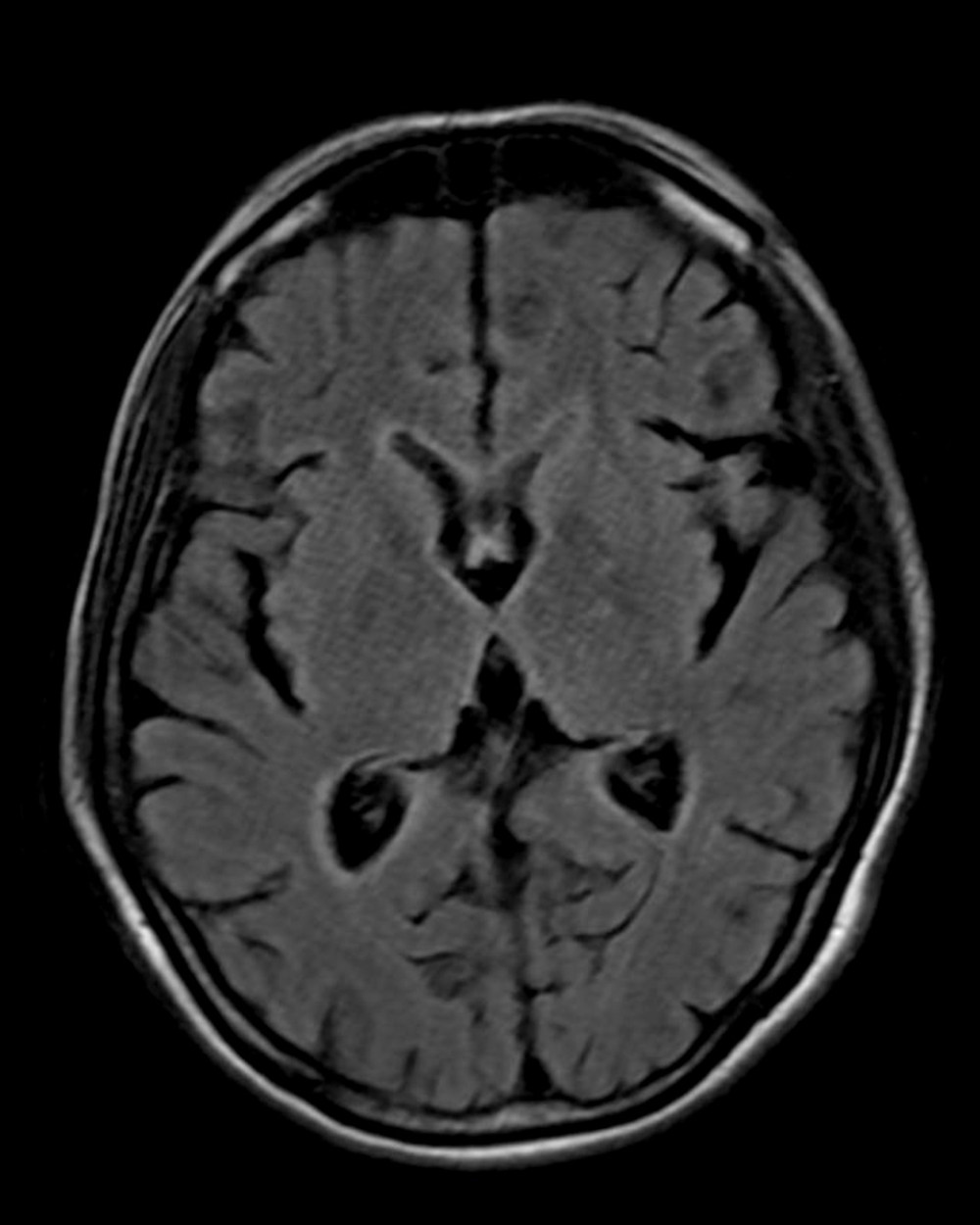 Magnetic resonance imaging (axial T2 flair), showing mild enhancement of the ventricular lining.