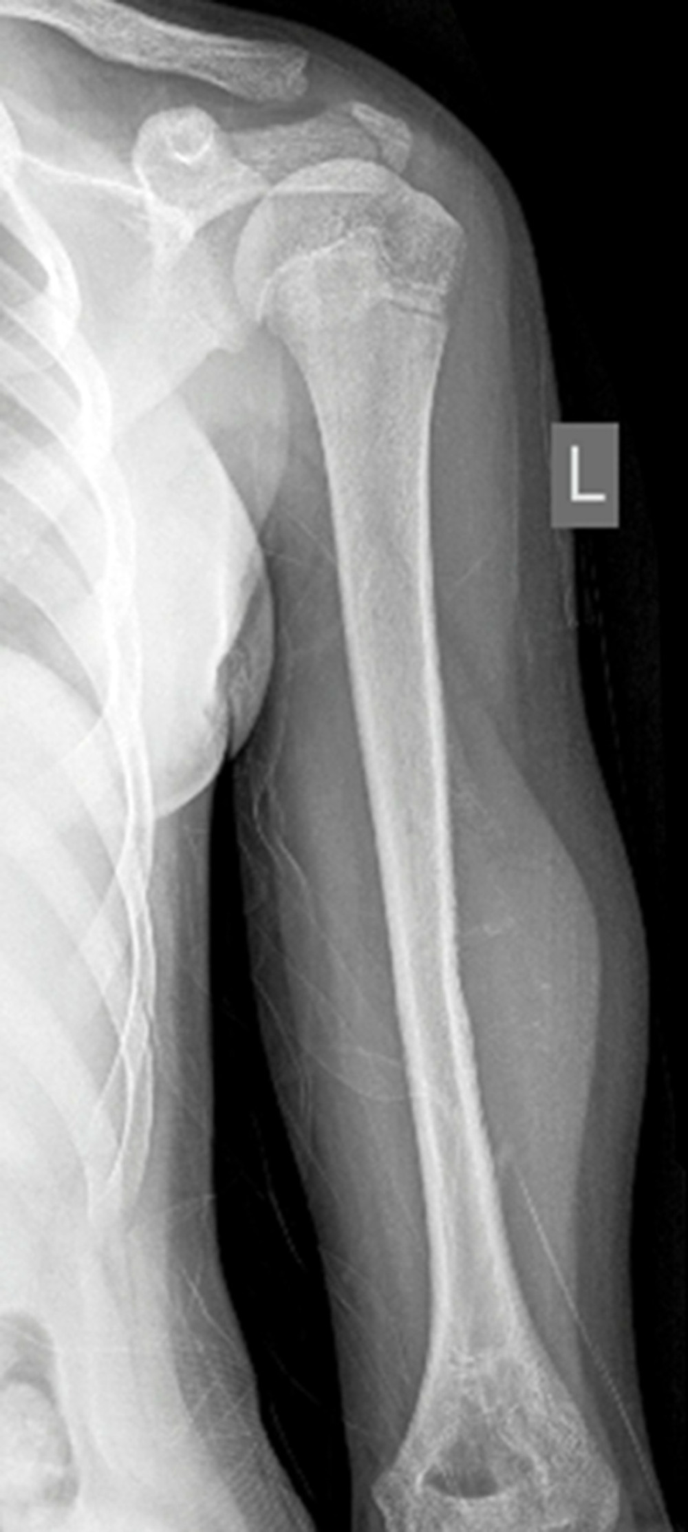 Plain radiograph of left humerus showing a soft tissue swelling with irregular cortex and periosteal reaction.