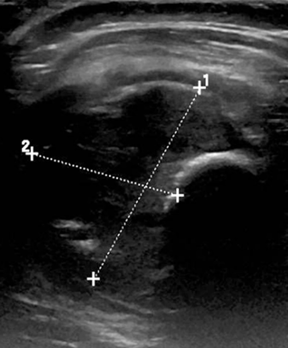 Ultrasound image showing the mass as a hypoechoic lesion with foci of calcification.