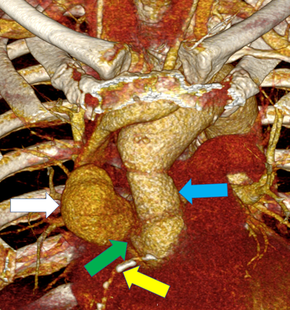 Three-dimensional reconstruction of aorta in computed tomography angiography. Pseudoaneurysm marked with white arrow. Antero-posterior view of the ascending aorta after the sternum and ribs were digitally removed. The highly calcified right coronary artery is located about 3 mm below the ascending aorta rupture (yellow arrow). This is where the pseudoaneurysm (white arrow) formed. The ascending aorta replaced with a graft is marked with the blue arrow. The green arrow points to the pseudoaneurysm stemming from the ascending aorta/anastomosis rupture. Pictures obtained from computed tomography (CT) scanner, General Electric Health Care Discovery CT750 HD.