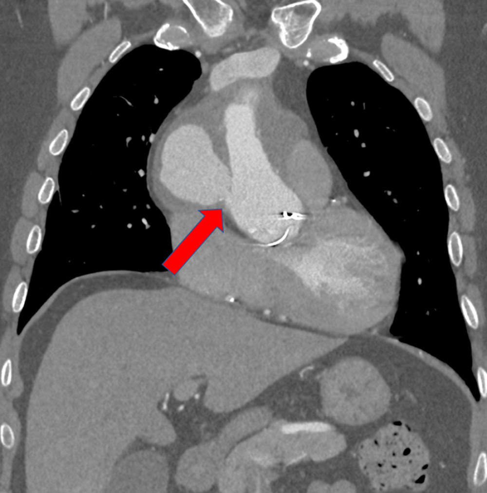 Narrow inflow channel into the pseudoaneurysm is marked with a red arrow. An antero-posterior computed tomography (CT) scan focused on a thin tunnel joining the ascending aorta and pseudoaneurysm lumens (red arrow). Pictures obtained from the CT scanner, General Electric Health Care Discovery CT750 HD.