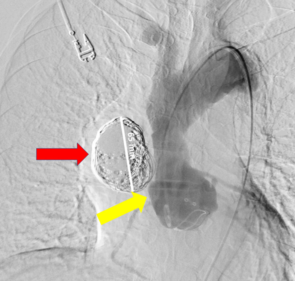 Postoperative angiography. Coils fill the pseudoaneurysm cavity (red arrow) completely. We see the diameter of the pseudoaneurysm excluded from the flow (major axis equals 65 mm). The yellow arrow shows an earlier detected outflow from the ascending aorta, which is no longer patent. Angiograph apparatus, Artis Zee Simens. Contrast agent, Optiray 320. Flow 20 mL/s, volume 40 mL.