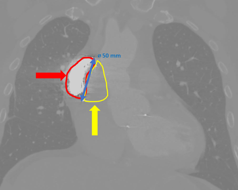 Postoperative computed tomography (CT) scan after 1 year. The red arrow shows the coils migrated and are more packed, filling half of the pseudoaneurysm. The yellow arrow shows the rest of the pseudoaneurysm cavity filled with clots. No inflow to the lumen of the pseudoaneurysm was detected. The diameter of the pseudoaneurysm is diminished from a maximum diameter of 65 mm to 50 mm. Picture obtained from CT scanner, General Electric Health Care Discovery CT750 HD.