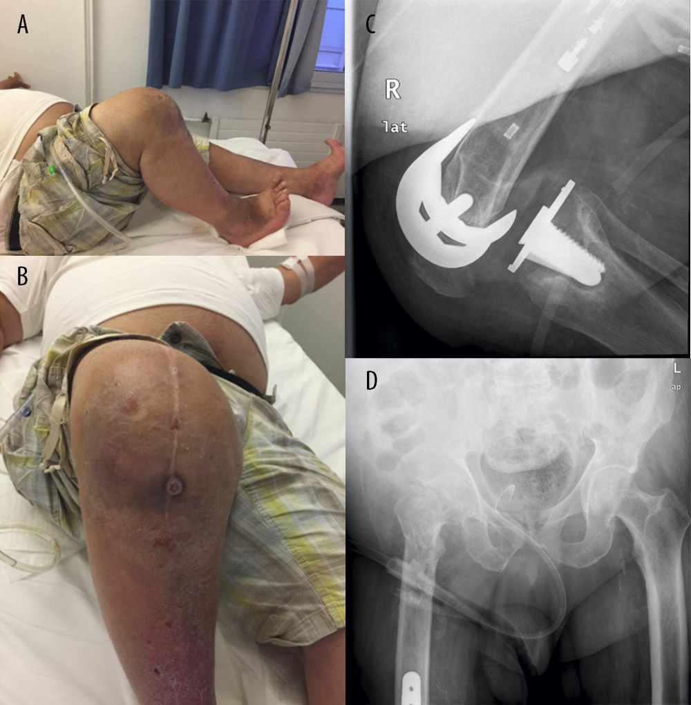 (A) Clinical preoperative picture of a fixed-flexion knee deformity with posterior tibial sag. (B) Clinical preoperative picture of the fistula in the anterior aspect of the proximal tibia. (C) Lateral radiograph demonstrating posterior TKA dislocation, implant loosening, and osteolysis especially in the tibia. (D) Anteroposterior radiograph of the pelvis showing previous hip surgery from a fracture, rotational deformity, and mild osteoarthritis.