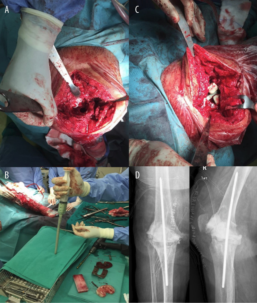 (A) Intraoperative photo after implants removal demonstrating marked bone loss especially in the femur. (B) Preparation of the intramedullary cemented rod. (C) Intraoperative photo after the application of the rod and bone-cemented cubes just prior to the application of the rest static spacer. (D) Postoperative anteroposterior and lateral radiographs after first-stage revision, showing good knee alignment.