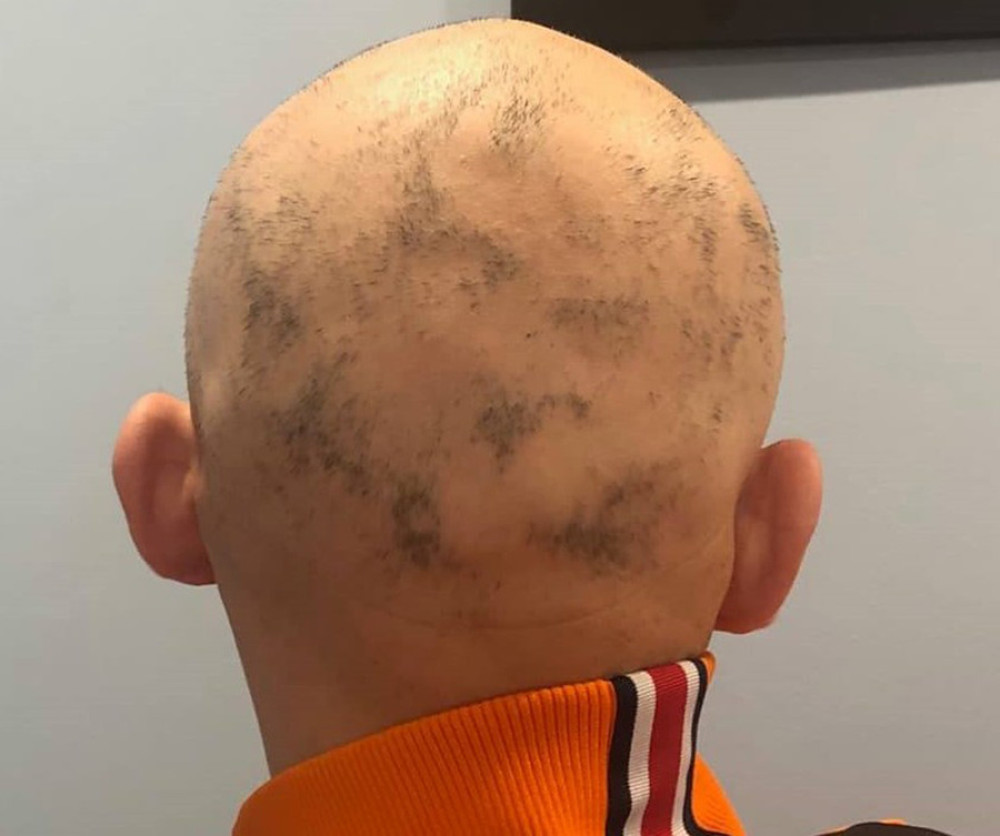 Alopecia on the scalp was one of the presenting symptoms of the patient.