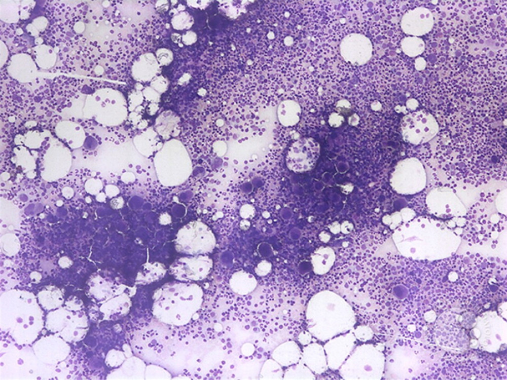 Bone marrow biopsy (40×) revealed slightly hypercellular marrow (70%) with trilineage hematopoiesis. The myeloid-to-erythroid ratio (M: E) was within normal range; increased number of megakaryocytes were present, consistent with immune thrombocytopenic purpura (ITP), no evidence of lymphoma or leukemia was seen, no stainable storage iron was noted, and no marrow fibrosis or granulomatous inflammation/necrosis identified. Given the past medical history of TB, the possibility of disseminated TB with bone marrow involvement was ruled out by negative AFB stain and culture for AFB.