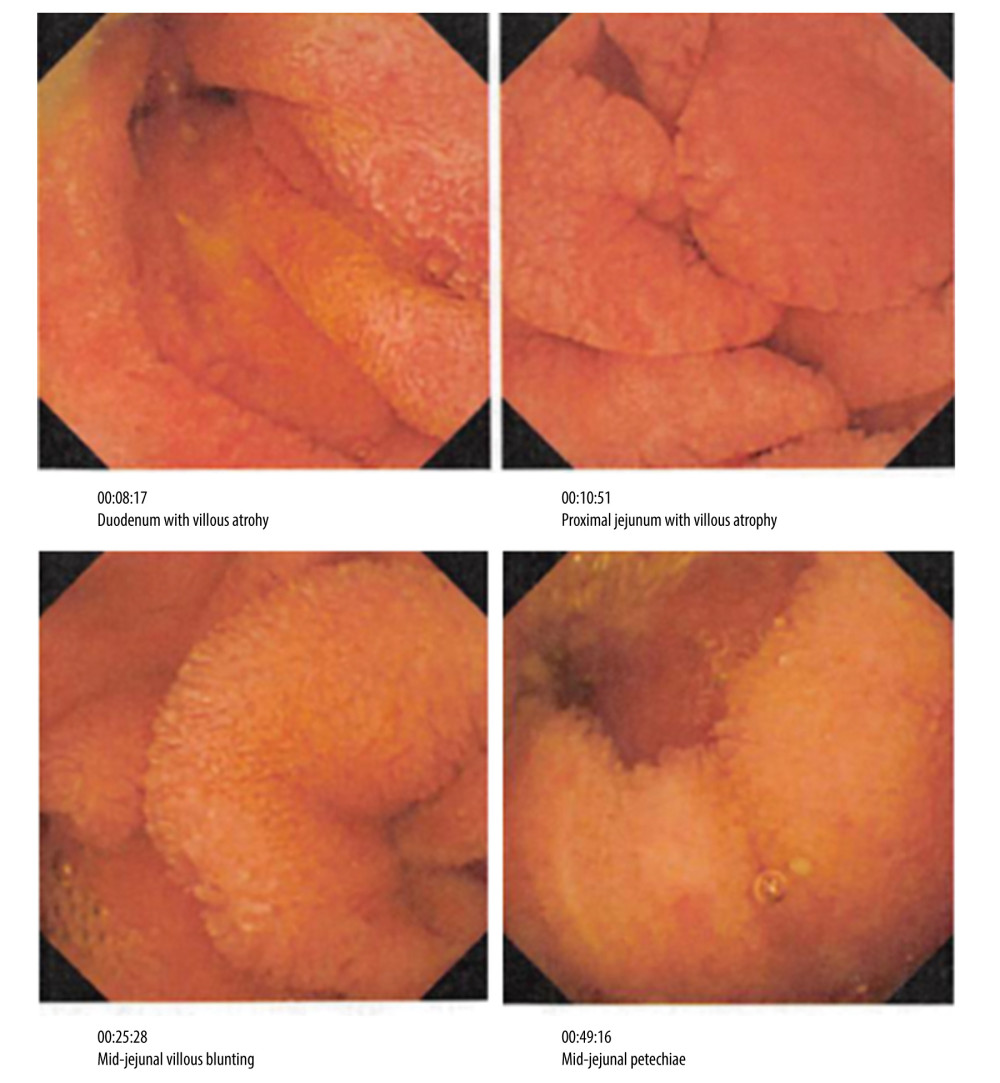 Capsule endoscopy: absence of the villi in duodenum and proximal jejunum; Villous blunting in the proximal jejunum. Findings are consistent with celiac disease.