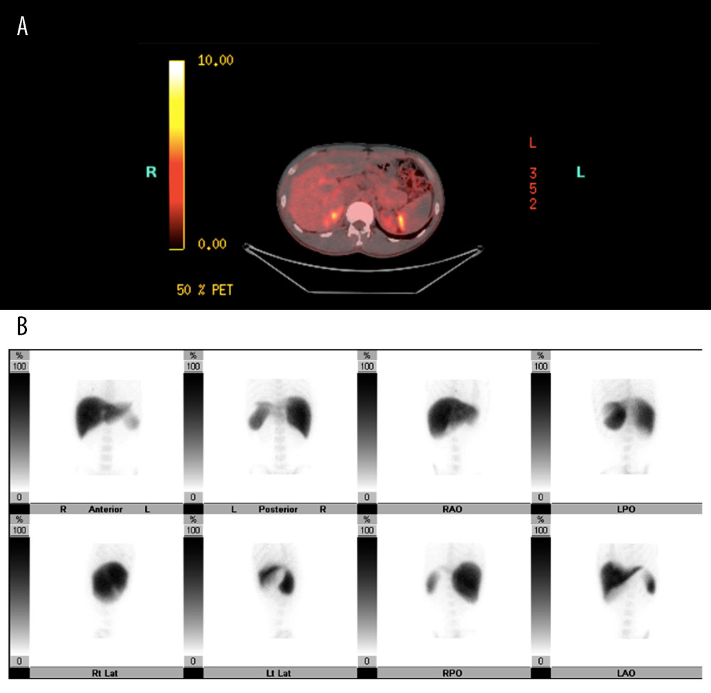 (A) PET imaging of the liver and spleen: Normal localization appearance of the liver, spleen, and bones with no significant evidence of hypersplenism. (B) PET/CT skull to mid-thigh with CT head, chest, abdomen, and pelvis without contrast: No lymphadenopathy in the neck, chest, abdomen, or pelvis.