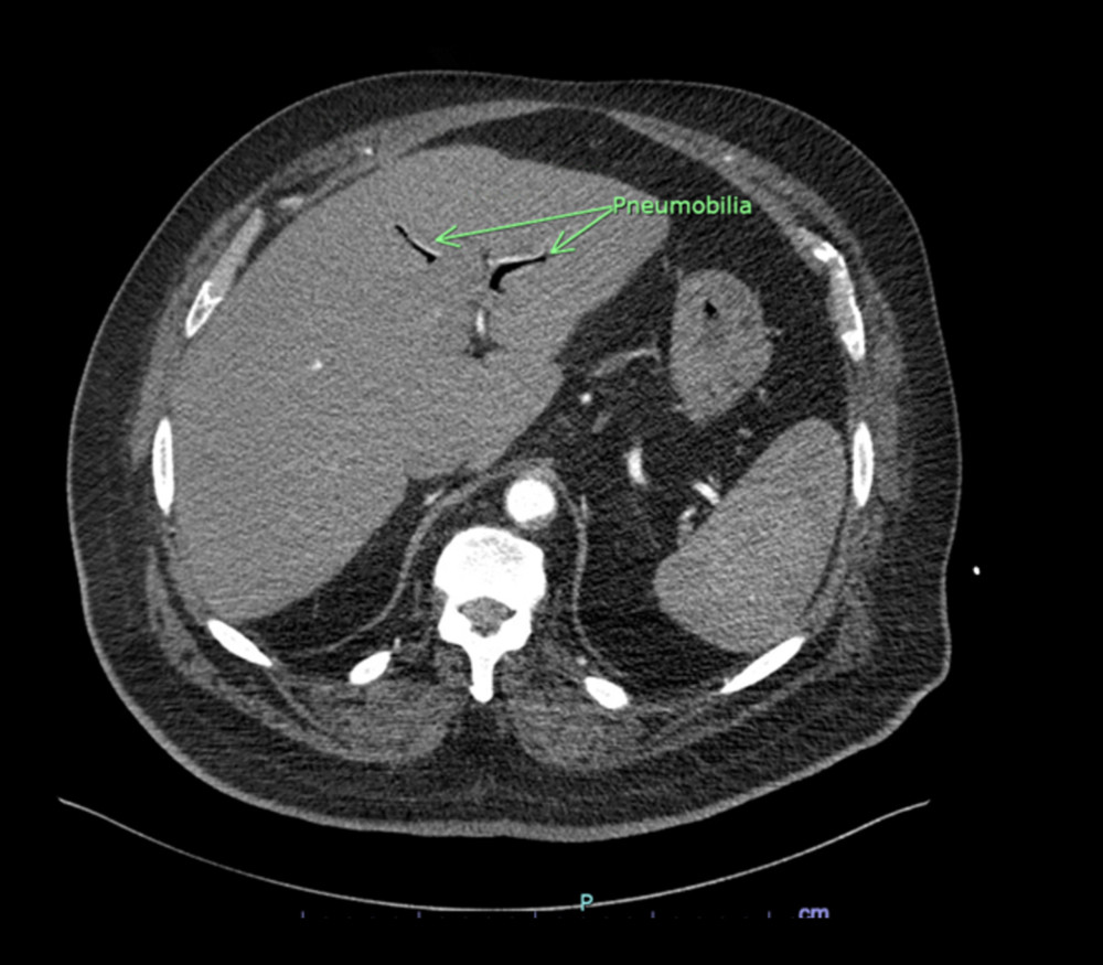 Axial abdominal CT angiogram showing air in the biliary tree (pneumobilia). Green arrows point to pneumobilia.