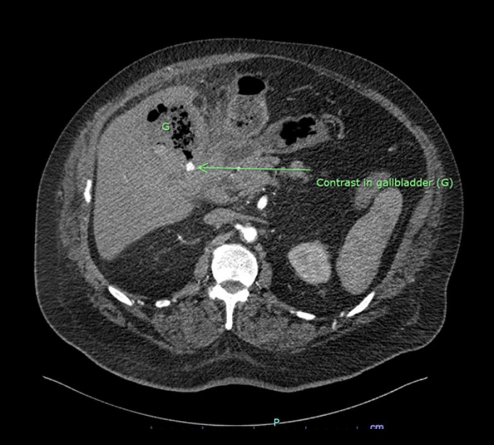 Axial abdominal CT angiogram showing contrast in the region of the gall bladder, suggesting ongoing bleeding.
