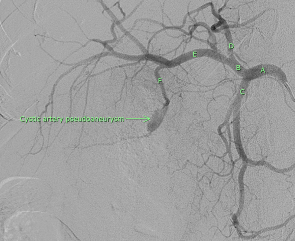Pre-embolization arteriogram showing cystic artery pseudoaneurysm. A – celiac trunk; B – proper hepatic artery; C – gastroduodenal artery; D – left hepatic artery; E – eight hepatic artery; F – cystic artery.