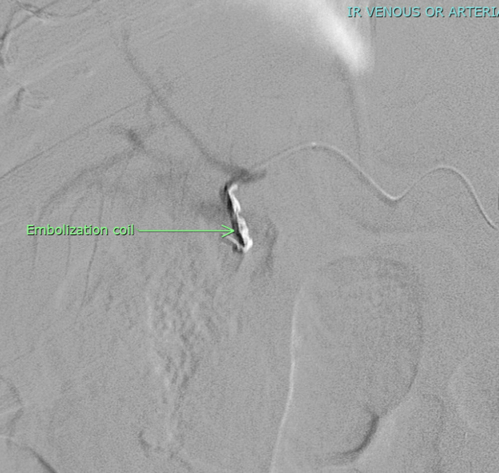 Post-embolization arteriogram with in-situ embolization coil in the region of gall bladder fossa.