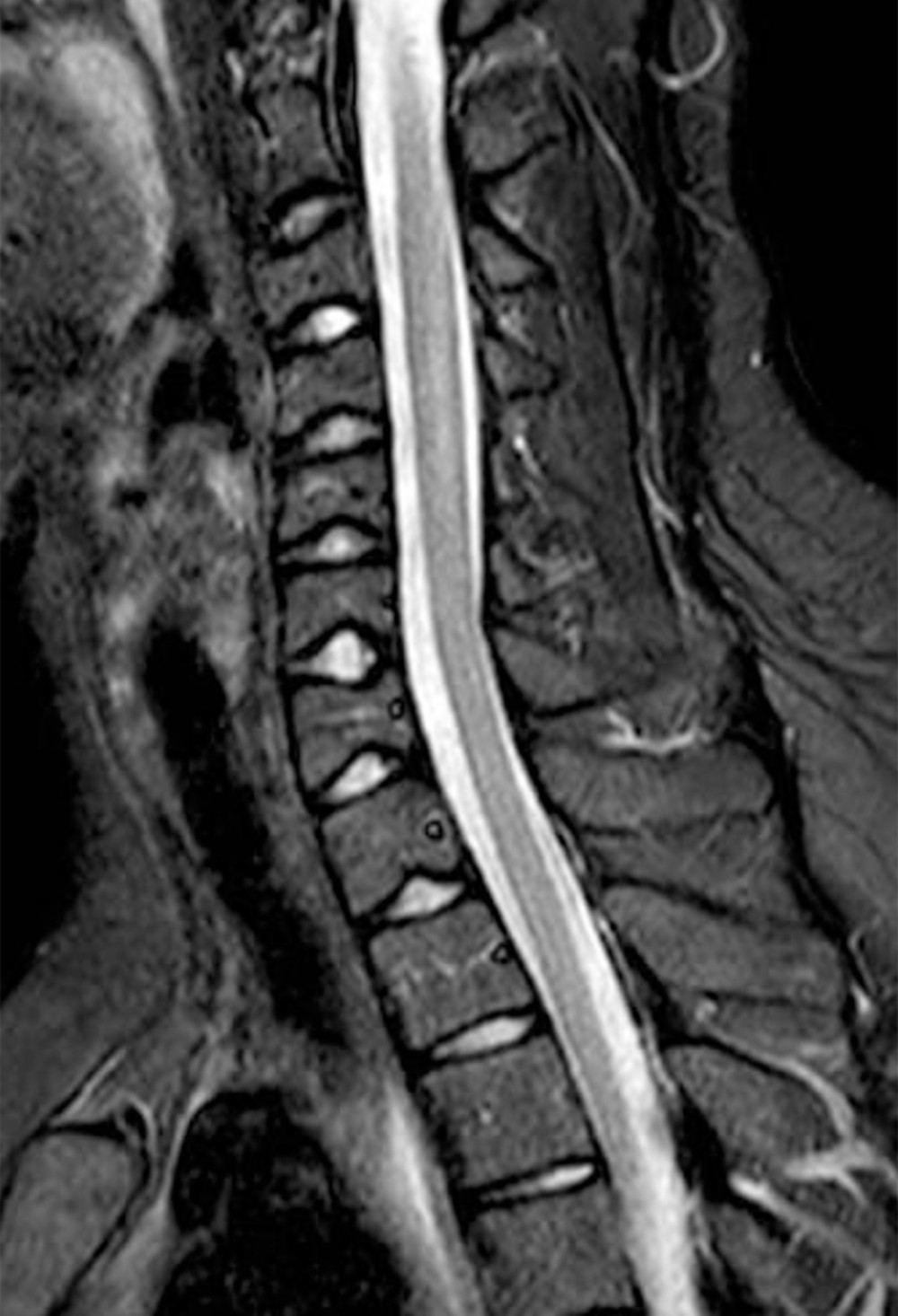 Magnetic resonance imaging (MRI) scan of the cervical column. The MRI did not reveal any definite pathological findings.