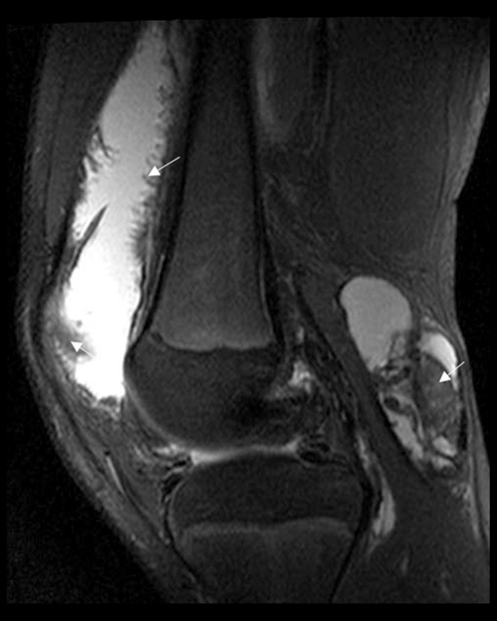 Sagittal proton density MRI of the knee showing large joint effusion with frond-like low signal intensity projections and lobulated masses seen in the suprapatellar recess and popliteal fossa (arrows).