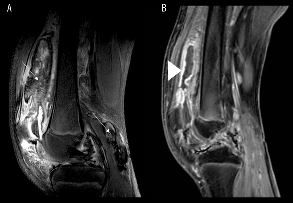 Sagittal MRI of the knee, 5 months after synovectomy. (A) Sagittal proton density with fat saturation. The joint effusion has resolved with persistent hemosiderin-stained synovium (arrows). (B) T1 post-contrast images with fat saturation demonstrating synovial enhancement (arrow head).
