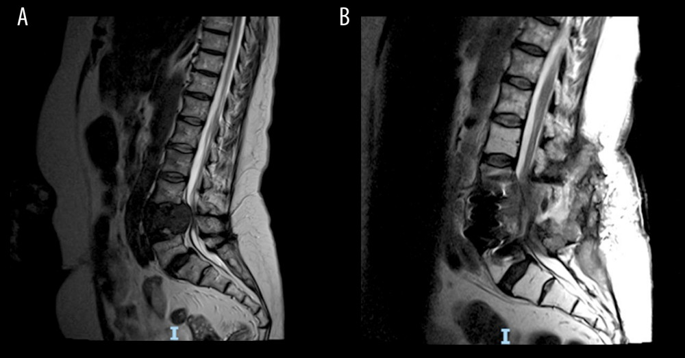 (A) Sagital T2-weighted magnetic resonance imaging (MRI) of lumbar-sacral spine showing cauda equina compression at L4 level at first presentation of differentiated thyroid cancer. (B) Sagital T2-weighted MRI of lumbar spine showing progressive disease, complex abscess formation, and cauda equina compression at L4 level at point of anaplastic thyroid cancer transformation.