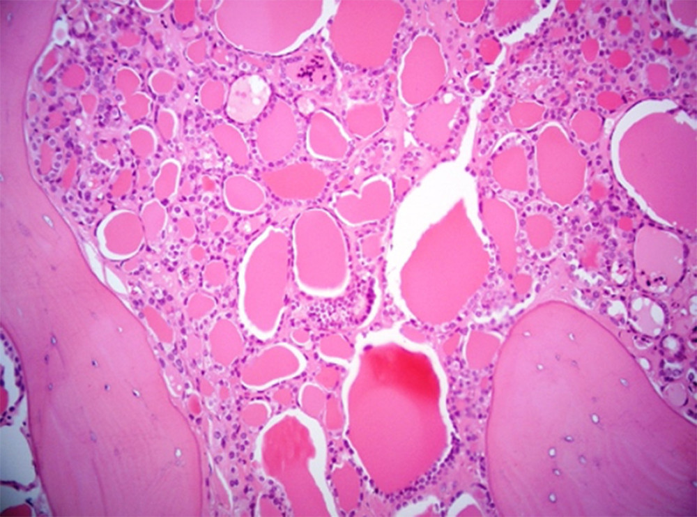 Hematoxylin- and eosin-stained biopsy specimen from L4 vertebra (2016) showing infiltration by metastatic well-differentiated thyroid carcinoma, ×200 magnification.
