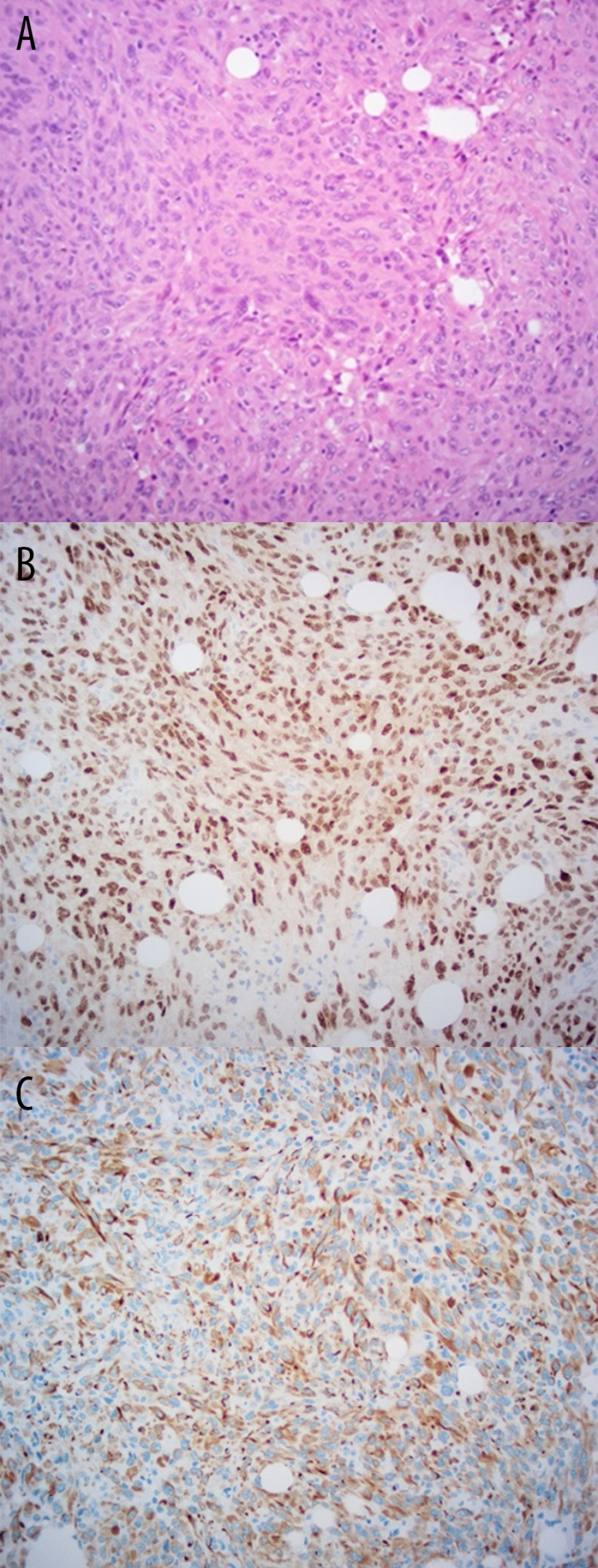 (A) Hematoxylin- and eosin-stained biopsy specimen from L4 vertebra (2020) showing a high-grade malignant tumor, ×200 magnification. Immunohistochemical staining for (B) Pax8 and (C) CK7.