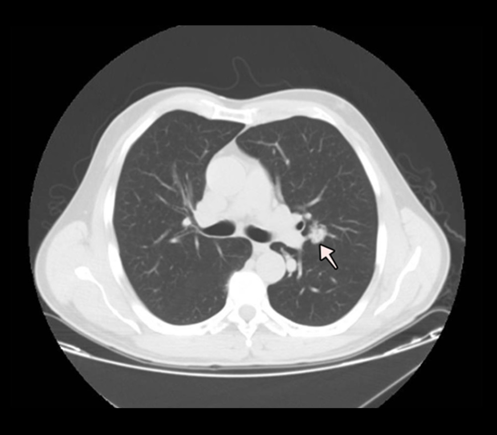 A thoracic computed tomography scan showing a pulmonary nodule with mixed solid and ground-glass opacity (21-mm diameter), located in the central aspect of the left upper lobe.