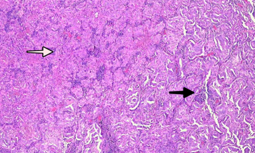 The moderately differentiated lung adenocarcinoma displayed a 40% solid (white arrow) and 60% acinar (black arrow) pattern (hematoxylin and eosin stain, 4× magnification).