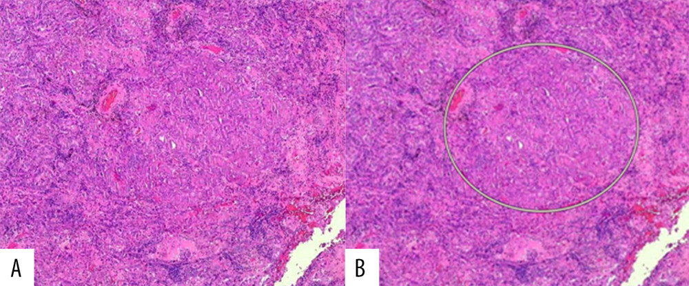 (A) Intratumoral metastasis of the papillary renal cell carcinoma type 2 measuring 0.2×0.2 cm, surrounded by a lung adenocarcinoma. (B) The circle encloses the intratumoral metastasis (hematoxylin and eosin stain, 10× magnification).