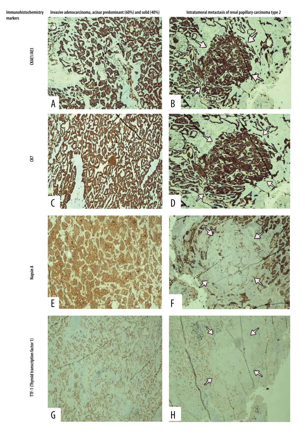 Immunohistochemical studies with positivity for CKAE1/AE3, CK7, Napsin A, and thyroid transcription factor 1 (TTF-1) in the acinar (60%) and solid (40%) lung adenocarcinoma. Positivity for CKAE1/AE3 and CK7, and negativity for Napsin A and TTF-1 for the metastasis from the papillary renal cell carcinoma (RCC) type 2 metastasis (arrows indicate intratumoral RCC metastasis): (A) CKAE1/AE3 in the lung adenocarcinoma (CKAE1/AE3 stain, 4× magnification). (B) CKAE1/AE3 in the intratumoral metastasis of the papillary RCC type 2 (CKAE1/AE3 stain, 10× magnification). (C) CK7 in the lung adenocarcinoma (CK7 stain, 4× magnification). (D) CK7 in the intratumoral metastasis of the papillary RCC type 2 (CK7 stain, 10× magnification). (E) Napsin A in the lung adenocarcinoma (napsin A stain, 4× magnification). (F) Napsin A in the intratumoral metastasis of the papillary RCC type 2 (napsin A stain, 10× magnification). (G) TTF-1 in the lung adenocarcinoma (TTF1 stain, 4× magnification). (H) TTF-1 in the intratumoral metastasis of the papillary RCC type 2 (TTF-1 stain, 10× magnification).