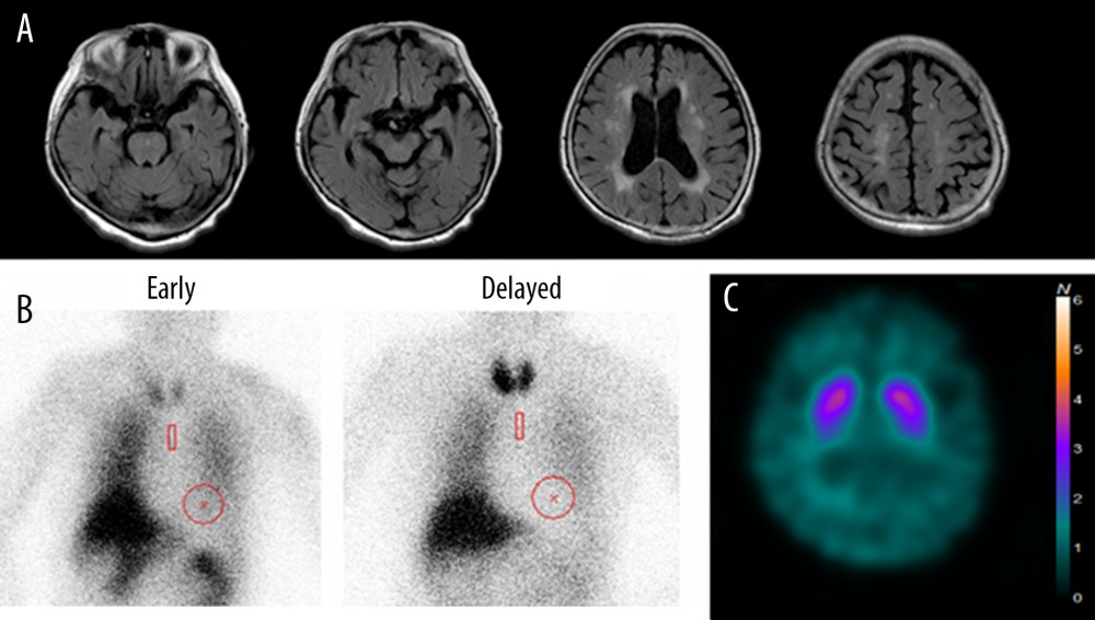 Neuroradiological findings. (A) Magnetic resonance fluid-attenuated inversion recovery image shows diffuse mild atrophy and mild leukoaraiosis. (B) Iodine 123-metaiodobenzylguanidine myocardial scintigraphy showing no decrease according to the heart-to-mediastinum ratios. (C) Iodine 123-N-omega-fluoropropyl-2-beta-carbomethoxy-3-beta (4-iodophenyl) nortropane single-photon emission computed tomography showing reduced dopamine transporter availability in the bilateral striatum. The average specific binding ratio (SBR) for the whole striatum using DaTView software (AZE Corp., Tokyo, Japan) was 2.77 (right striatal SBR=3.05; left striatal SBR=2.48).
