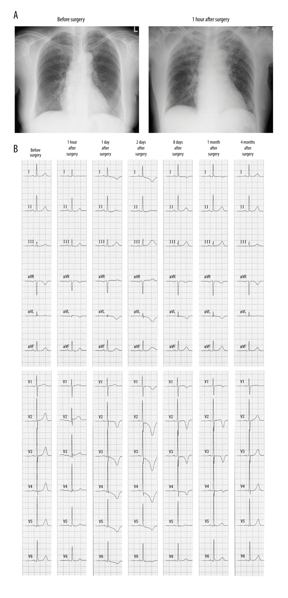 Time change of electrocardiography. Chest X-ray results and time changes of 12-lead electrocardiography (ECG) after surgery. (A) Preoperative and postoperative chest X-ray results. (B) The 12-lead ECG demonstrated slight ST-segment elevation in precordial lead V2 and slight depression in leads V3 to V6 at 1 h after surgery; additionally, a giant negative T wave occurred on postoperative day 2 but was resolved 4 months later.