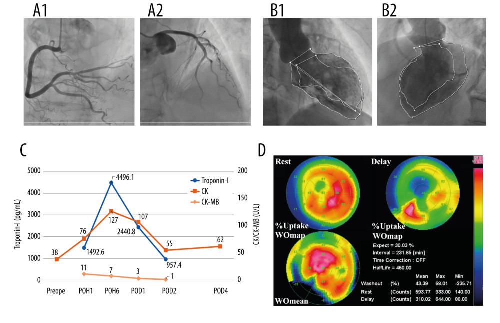 Postoperative examinations. (A) Postoperative coronary arteriography showed no significant stenosis in the coronary artery. (B) Left ventricular angiography revealed akinesis from the area of the apex to the left ventricle anterior wall. (C) Blood examination demonstrated normal levels of creatine kinase isozyme-MB and elevated levels of creatine kinase and troponin-I at the peak, 6 h after surgery. (D) 123I-metaiodobenzylguanidine myocardial scintigraphy on postoperative day 8 shows decreased accumulation in the septum and increased accumulation in the base. POH – postoperative hour; POD – postoperative day.